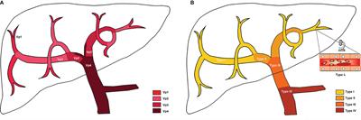 The Progress in the Treatment of Hepatocellular Carcinoma With Portal Vein Tumor Thrombus